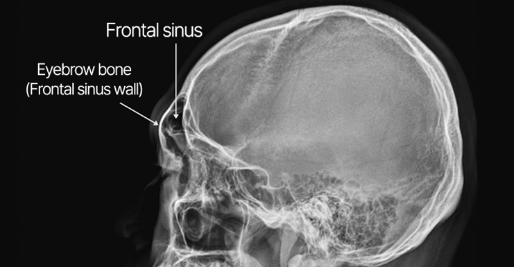 Frontal sinus X-ray